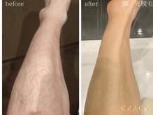 グレイス 久留米店(GRACE)/足　光脱毛