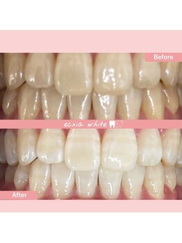 エクシアホワイトニング 札幌琴似店/ホワイトニングビフォーアフター