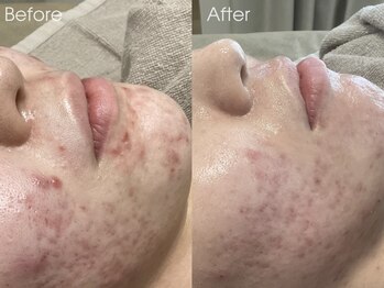 リアン(Rien)/Before/After(初回から3回後)