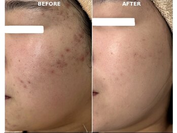 プリベンティブ ビューティー ティップス(Preventive Beauty Tips)/ニキビ改善ビフォーアフター