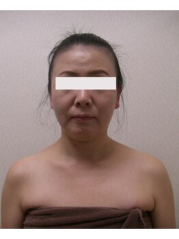 ジョイア 本店(Beauty＆Detox gioia)/塩尻市40代のお客様お顔ビフォー