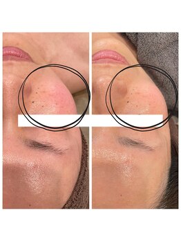 モカプラス(mocha plus)/赤ら顔軽減