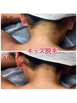 エヌアール(NR)/キッズ うなじ