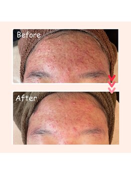 縁 整体院 和歌山院(en)/ハーブピーリング