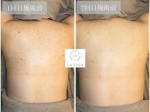 ラヴィオーラ 明石店(La Viora)/ダイヤモンドハーブピーリング