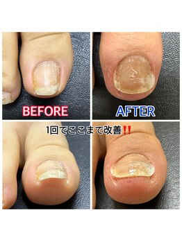 キラキラフット神領 ありが接骨院/巻き爪/フットケア