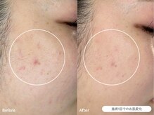 フォンビューティー(fon beauty)/6年間のお悩みが1回の施術で♪