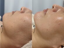 イエローウィーン(YELLOWEEN.)/赤みのケア