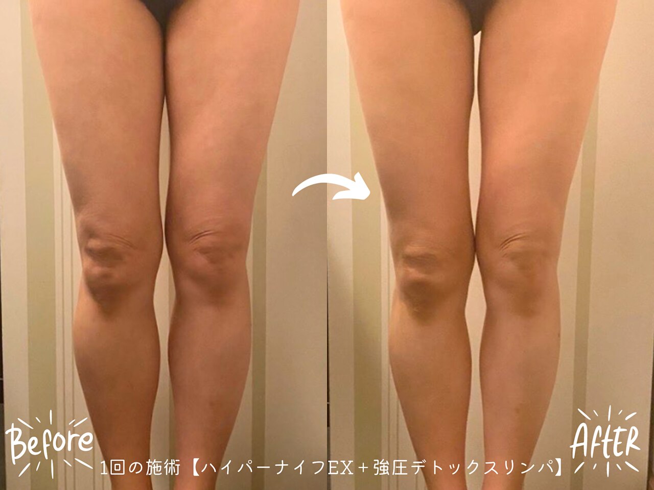 新型ハイパーナイフEX/筋膜リリースシェイプ』×『当店自慢の独自 新型ハイパーナイフEX/筋膜リリースシェイプ』×『当店自慢の独自