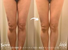 『ハイパーナイフEX』×『強圧デトックスリンパマッサージ』で本気の結果出しをお約束いたします。