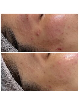 ティアーナ(Tiaana)/トラネキサム酸イオン導入