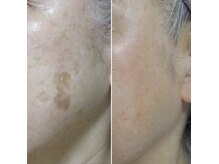 お肌悩みの方に知って欲しい！ADS美肌プログラム取り扱い