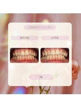 プラスビー 2号店(+b)/ホワイトニングビフォーアフター