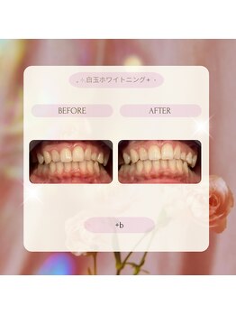 プラスビー 2号店(+b)/ホワイトニングビフォーアフター