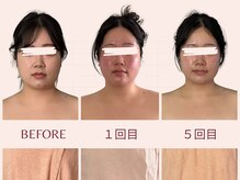 アンリール(Anrire)/【板橋/フェイシャルエステ】