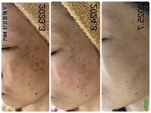 アップル 宇都宮店(Apple.)/肌質改善プログラム