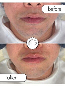 久遠(クオン)/メンズ ヒゲ脱毛 2025/9/20