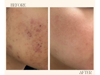 レヴ 都城店(rev)/繰り返すニキビに