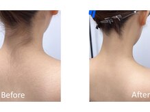 結果にこだわる脱毛メニュー