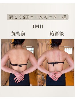 きぃ オリジンプラス(きぃ origin+)/肩こりbefore after