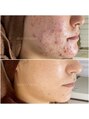 ビューティーホリック 蘇我店(BEAUTY HOLIC)&nbsp;プログラム体験のお客様