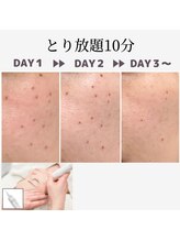 【肌管理×小顔・毛穴改善フェイシャルサロン】MavY.塚口店【3月 NEW OPEN(予定)】/シミケア☆10分取り放題