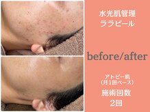 ウィア 越谷店(Uvia)/韓国肌管理・艶・ハリ/越谷