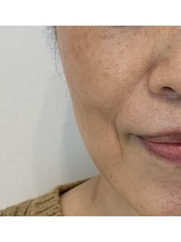 シーフェイス(see face)/ほうれい線改善