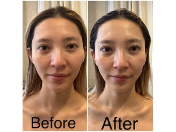 ケイビューティーサロン(K BeautySalon)/小顔リガメント(顔靱帯)コルギ