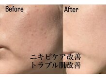 イリゼ(IRISE)/寒暖差＆乾燥肌トラブル肌対応