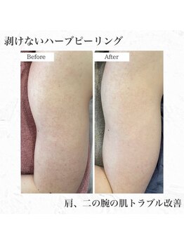 ラヴェンナサロン 札幌店(Ravenna salon)/二の腕のトラブル改善◎