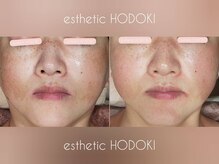 エステティックホドキ(esthetic HODOKI)の雰囲気（濃いものや広範囲ケアはシミケア集中でしっかりとケアします！）