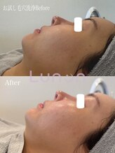 ルノン(Lunon)/お試し毛穴洗浄ハイドロ