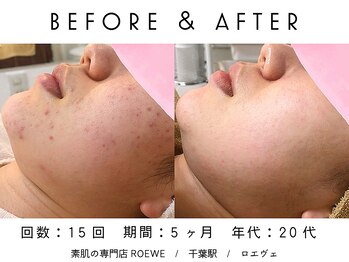 ロエヴェ(ROEWE)/ニキビ改善・毛穴ケア・肌質改善