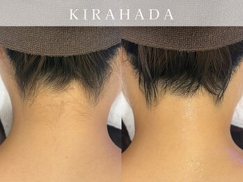 キラ肌 出雲店/うなじ脱毛