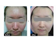 グリーンノート(GREEN NOTE)/ハ－ブピ－リング