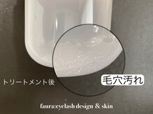 ファウラ(faura:)/ハイドロフェイシャル