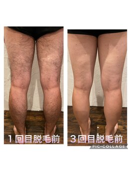 サロン ド リア(salon de Lia)/メンズ全身脱毛