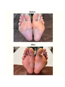 サロン ポノ(pono)/角質ケアのビフォー・アフター