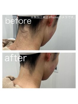 ラクシー 北千住(luxssy)/うなじシェービング