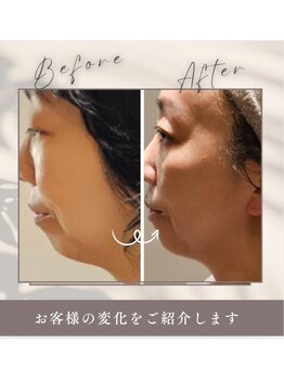 アン 銀座(ann)/アゴ骨が小さいと…