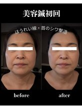 治楽院よう/美容鍼/電気美容鍼