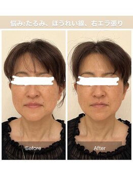 カドル 新宿店(KADORU)/小顔矯正+美容機器 Before-After