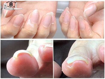 ネイルエイト 新百合ヶ丘(nail8)の写真/【大人のトラブル爪悩み】深爪・巻き爪・厚い爪もプロの技で美しく。諦める前に、当店へご相談を！
