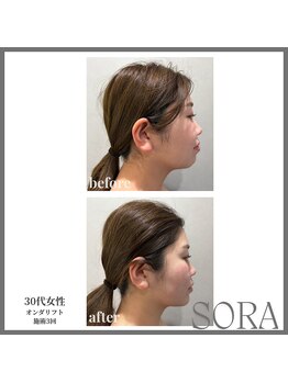 青空 天神大名店(SORA)/オンダリフト1回60kj