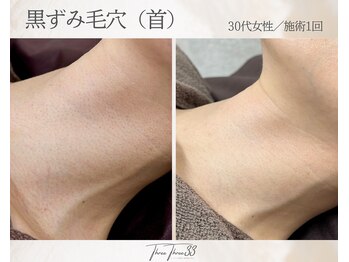 スリースリー 恵比寿(THREE THREE)/毛穴角栓・毛穴黒ずみ・毛穴開き