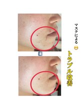 アイリス(AIRIS)/フェイシャル/毛穴洗浄/美白