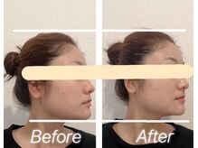 ナチュラルセラピー ドロップ(Drop)/小顔矯正 /エアバリ