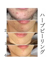 インディバケアプラチナム 横浜店/ハ-ブピ-リング≪フェイシャル≫