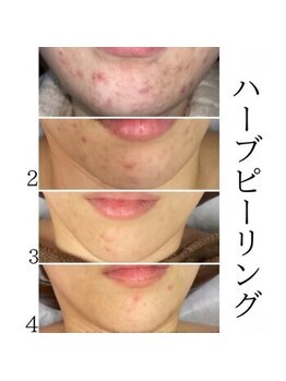 インディバケアプラチナム 横浜店/ハ-ブピ-リング≪フェイシャル≫